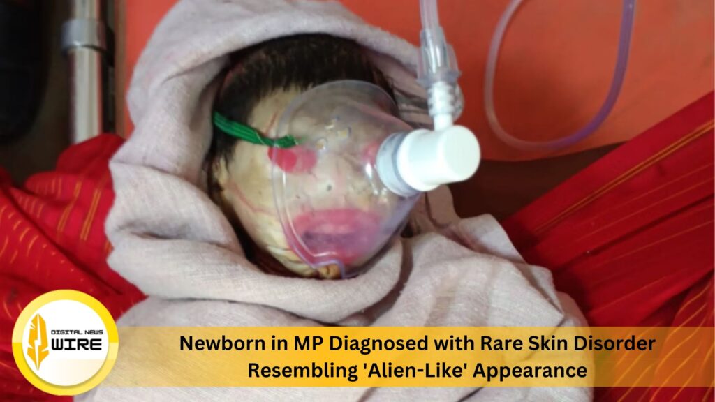 Newborn in MP Diagnosed with Rare Skin Disorder Resembling 'Alien-Like' Appearance