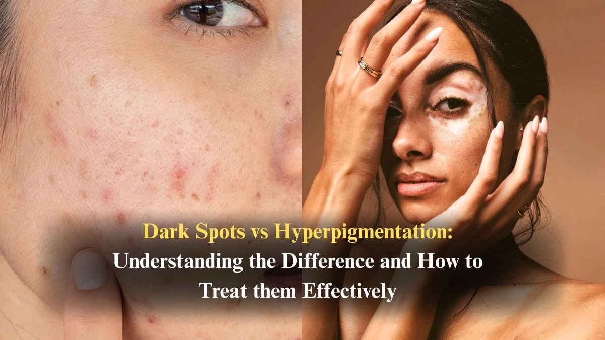 Dark Spots vs Hyperpigmentation